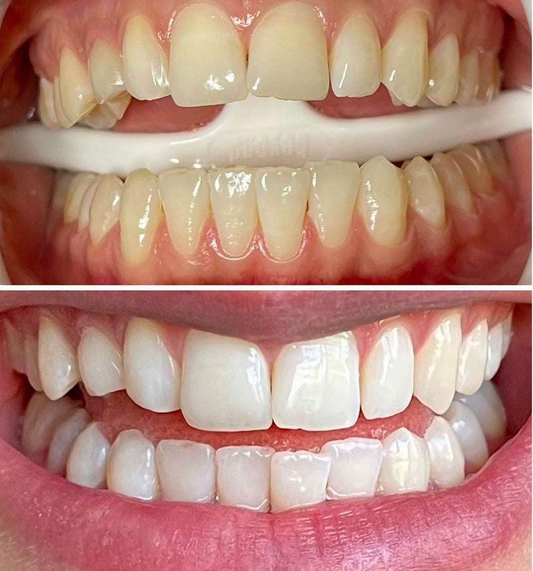 Teeth Whitening - Average Stain