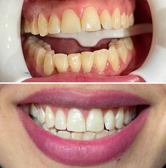 Teeth Whitening - Heavy Stain