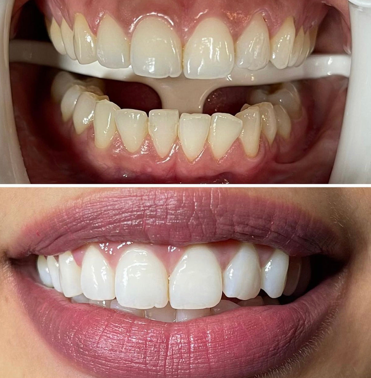 Teeth Whitening - Slight Stain